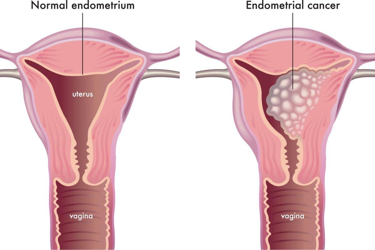 Frauen mit fortgeschrittenen ode rezidivierten Endometriumkarzinomen profitierten von einer Erhaltungstherapie mit Dostarlimab.