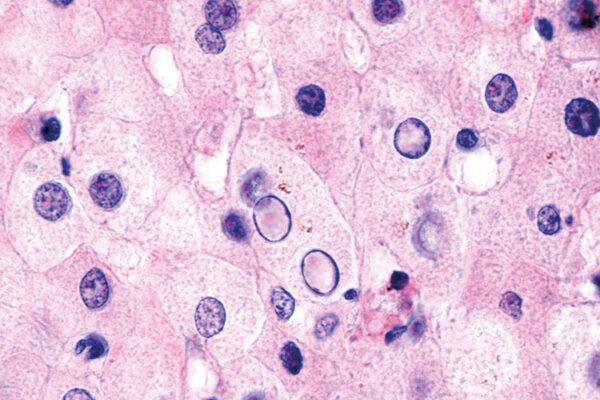Vakuolen in den Kernen von Leberzellen sind ein sicheres Zeichen für eine MASLD.