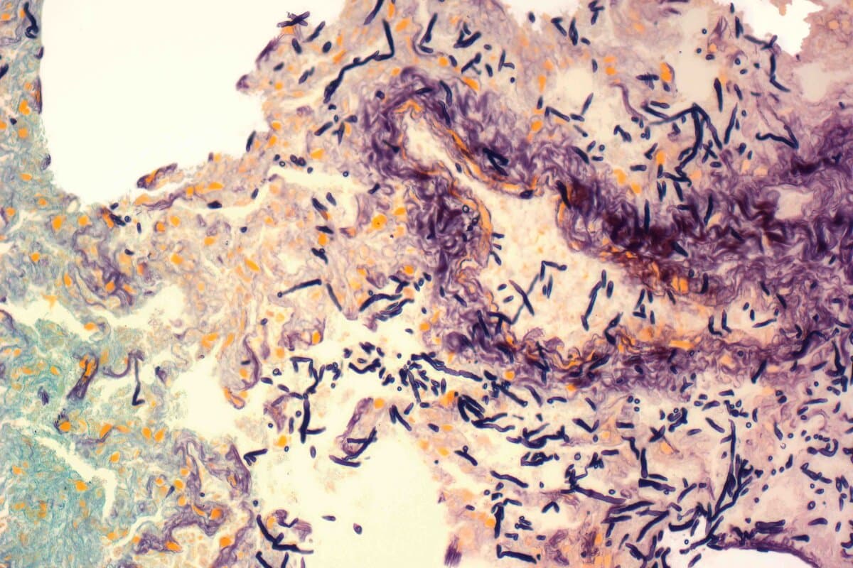 Lung fungal infection. Light micrograph (LM) of a section of lung from a patient with pulmonary candidiasis. Pulmonary candidiasis is a form of pulmonary fungal infection and refers to an opportunistic infection of the lung with the fungus Candida albicans (black). This organism is part of the normal human microbial flora of the oral cavity.