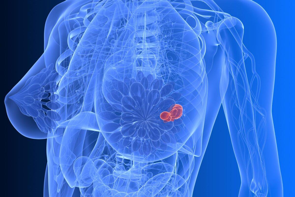 Durch eine endokrine Chemoprävention lassen sich viele HR+ Mammakarzinome verhindern.