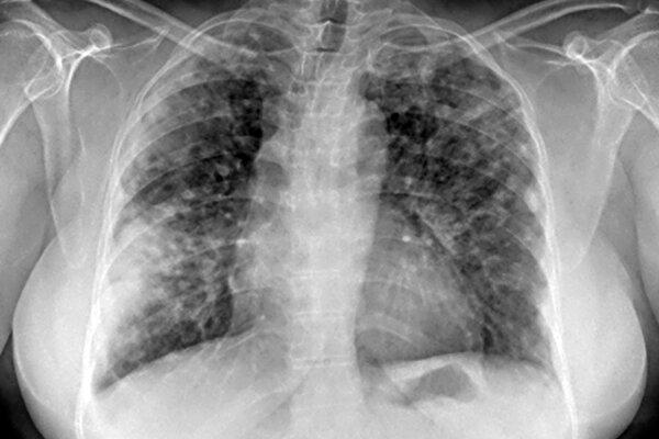 Radiographie thoracique d'une femme atteinte de pneumopathie interstitielle due à une amyloïdose pulmonaire.