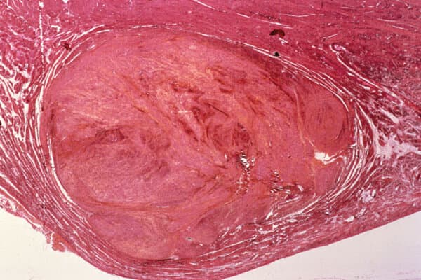 Micrographie lumineuse d'un fibrome utérin