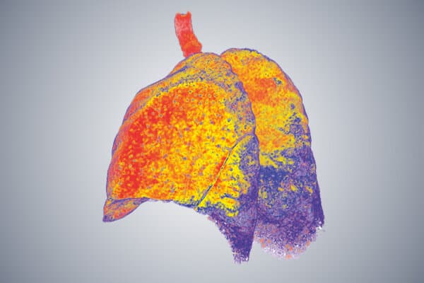 CT 3D d'un poumon humain avec maladies