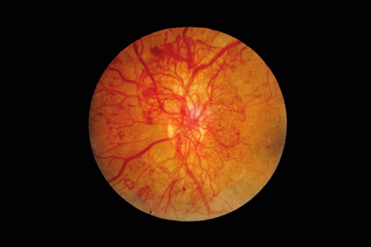 Ophthalmoscopy of eye with diabetic retinopathy
