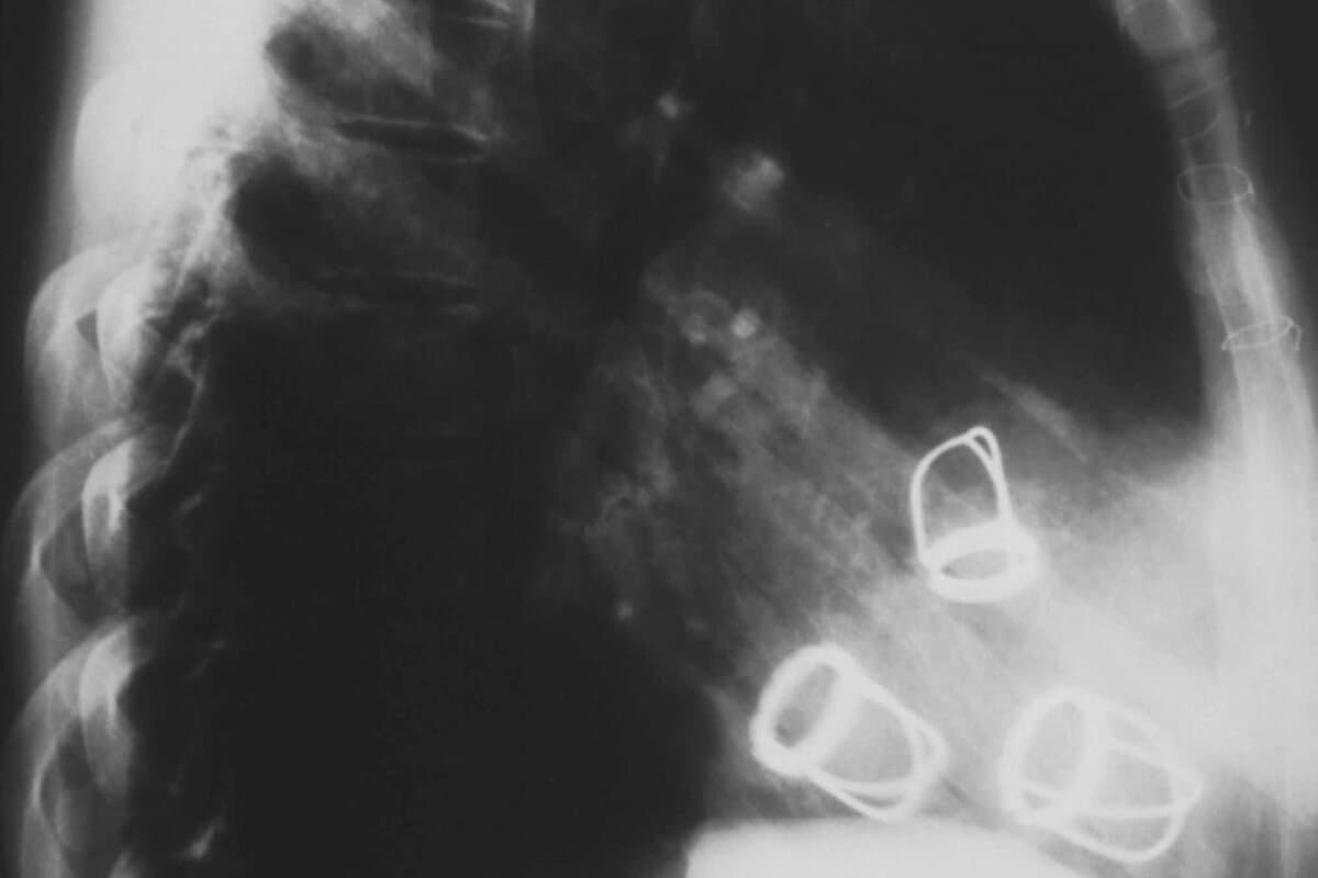 X-ray showing prosthetic heart valves in situ