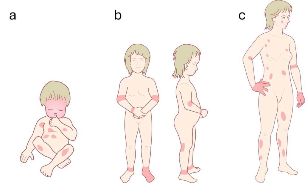 Die atopische Dermatitis betrifft je nach Alter unterschiedliche Körperbereiche.