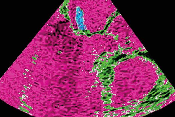 Une échocardiographie en coupe frontale montre une endocardite avec des proliférations sur une valve pulmonaire