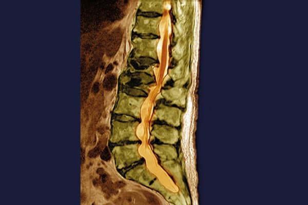 MRI einer Wirbelsäule eines Patienten mit Osteoporose zeigt eine Dislokation der Bandscheibe aufgrund osteoporotischer Kompressionsfraktur