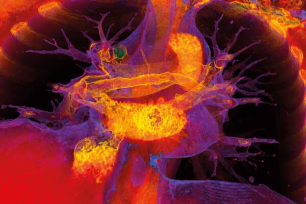 Scanner 3D d'une embolie pulmonaire