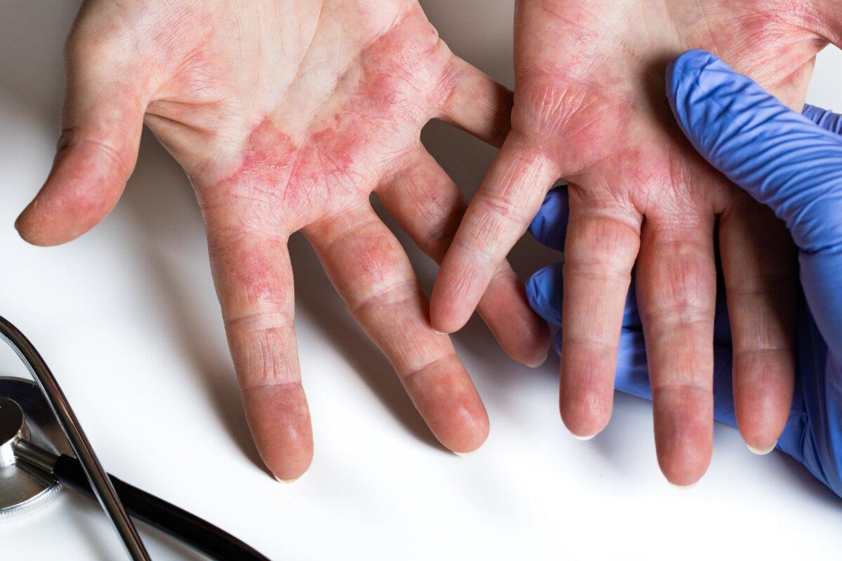 Chronic hand eczema management and a view into the future