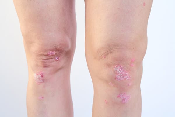 Zwei Knie mit Psoriasis