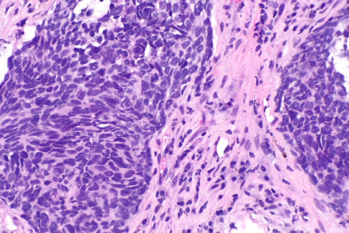 NSCLC, H&E-Färbung, stark vergrössert.