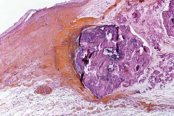 micrographie lumineuse de l'endocardite infectieuse