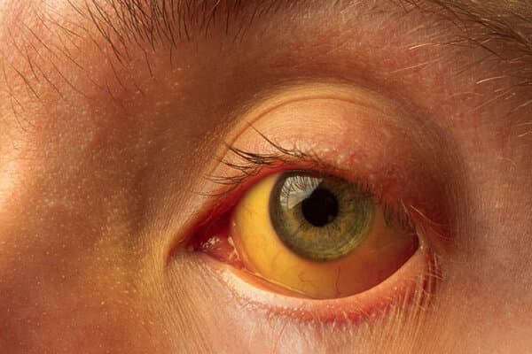 coloration jaune de la sclérotique de l'œil dans les maladies du foie, la cirrhose, l'hépatite, la bilirubine