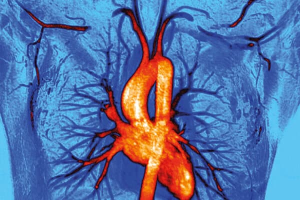 MRI Angiogram Thoracic Outlet Syndrome