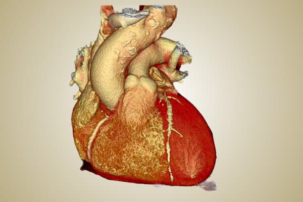 Farbige 3D-Computertomographie (CT)-Angiogramm-Aufnahme, die atheromatöse Plaques in den Herzkranzgefäßen zeigt.