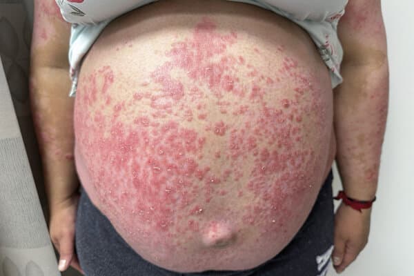 Ein schwangerer Bauch mit Psoriasis