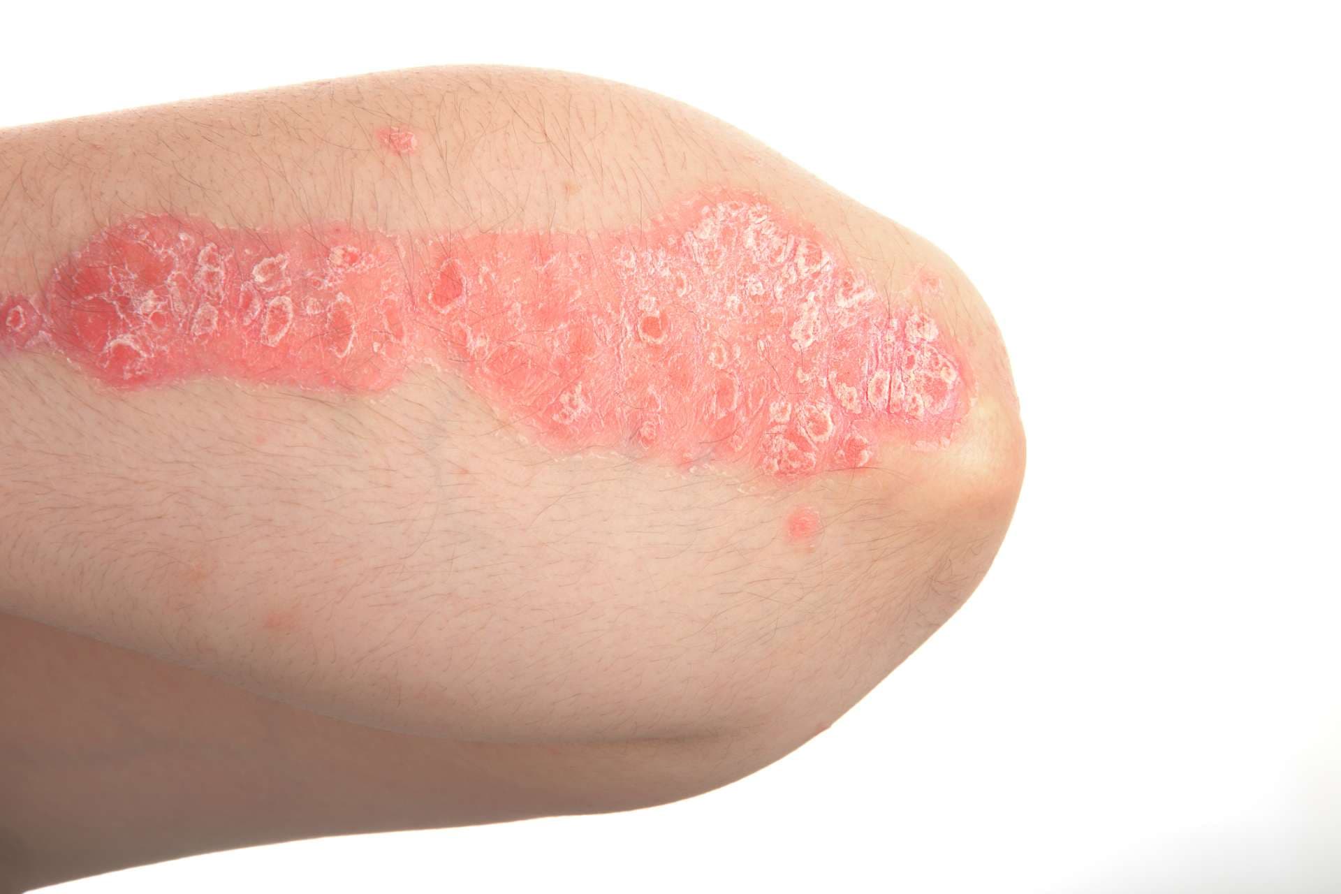 Psoriasis, dermatologic diseases.