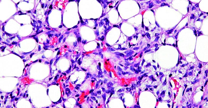 MTA_MTCH_2021_07_S13_wiki_Dedifferentiated_liposarcoma-very_high_mag.jpg