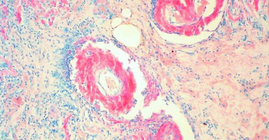 MT_CH_2021_KW05_MTCH_Rheuma_2020_05-06_S11_wiki_Gastric_Amyloidosis_(Congo_Red_Stain)_(3595839154).jpg