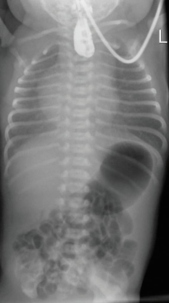 MT_CH_2021_KW18_MTCH_Paed_2021_01_S09_wikimedia_Hellerhoff_Oesophagusatresie3b