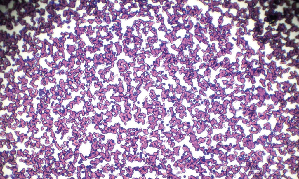 Chronic lymphocytic leukemia (CLL) blood smear under light microscopy