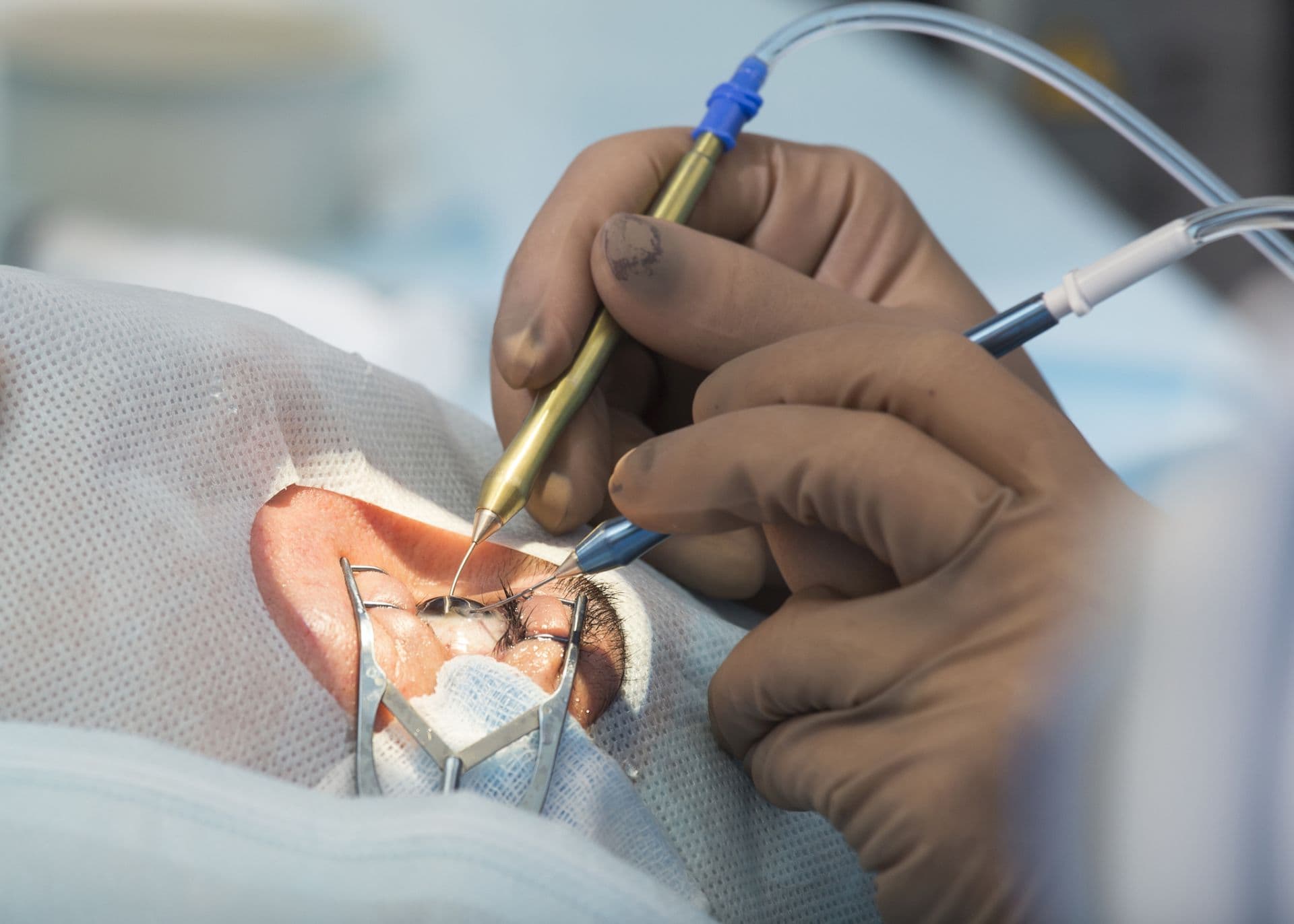 Dank Innovationen in der Augenchirurgie lassen sich auch Fehlsichtigkeiten bei der Star-OP korrigieren.