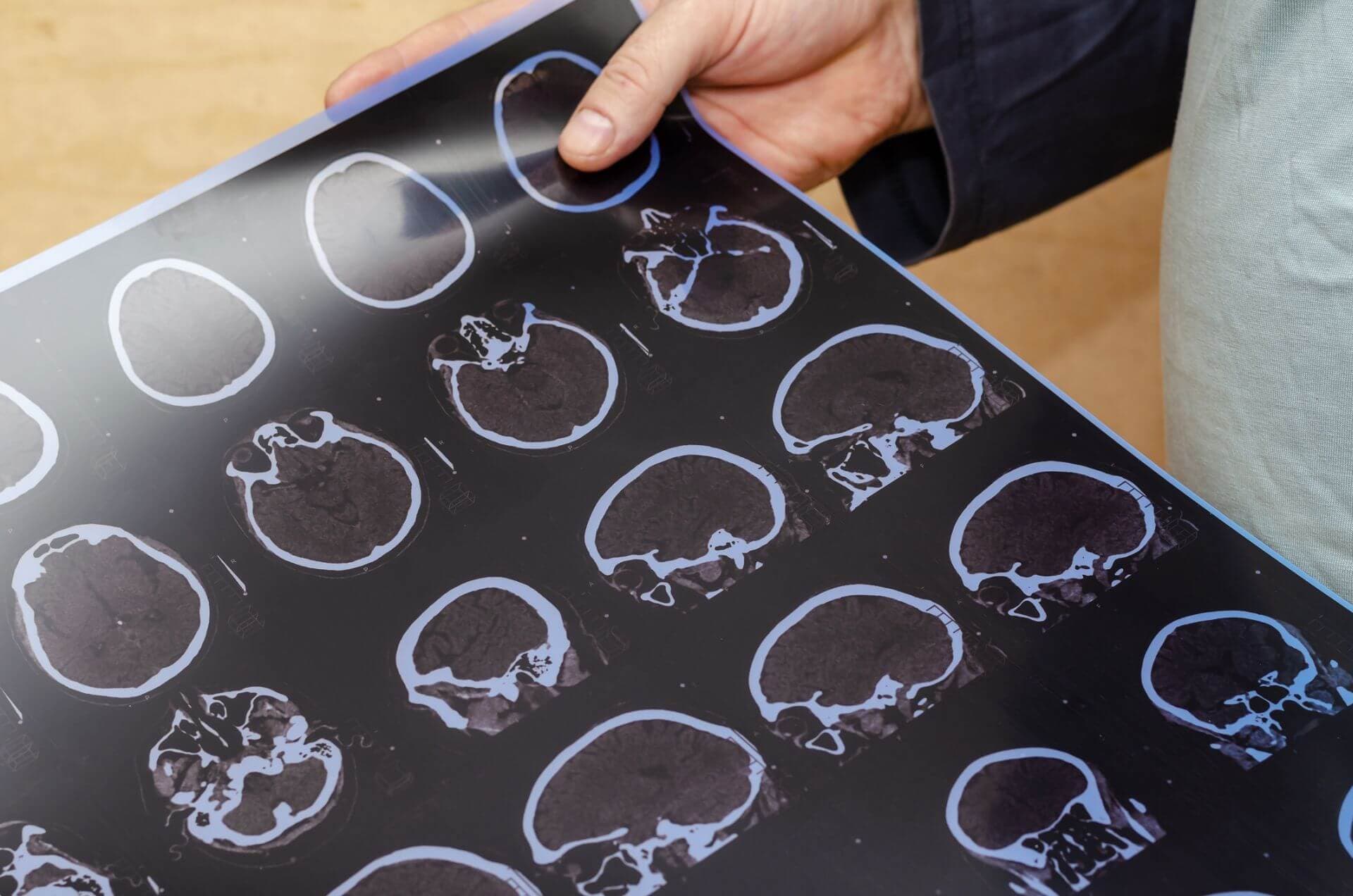 Nicht nur mittels CT, sondern auch mittels Biomarkern, lässt sich vielleicht in Zukunft ein Hirnschaden vorhersagen.