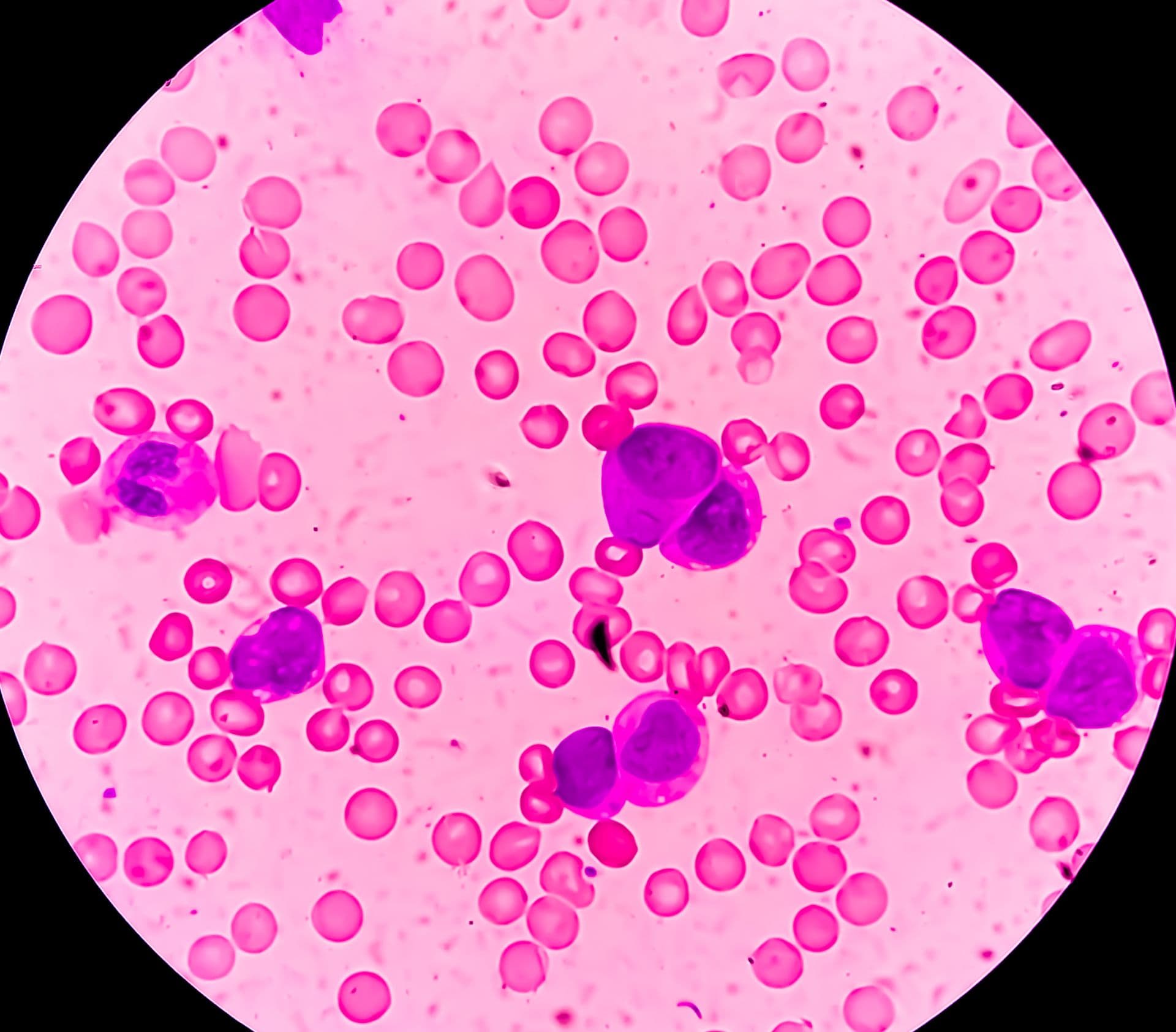 Gilteritinib ist bei Patienten mit refraktärer oder rezidivierter AML gut wirksam