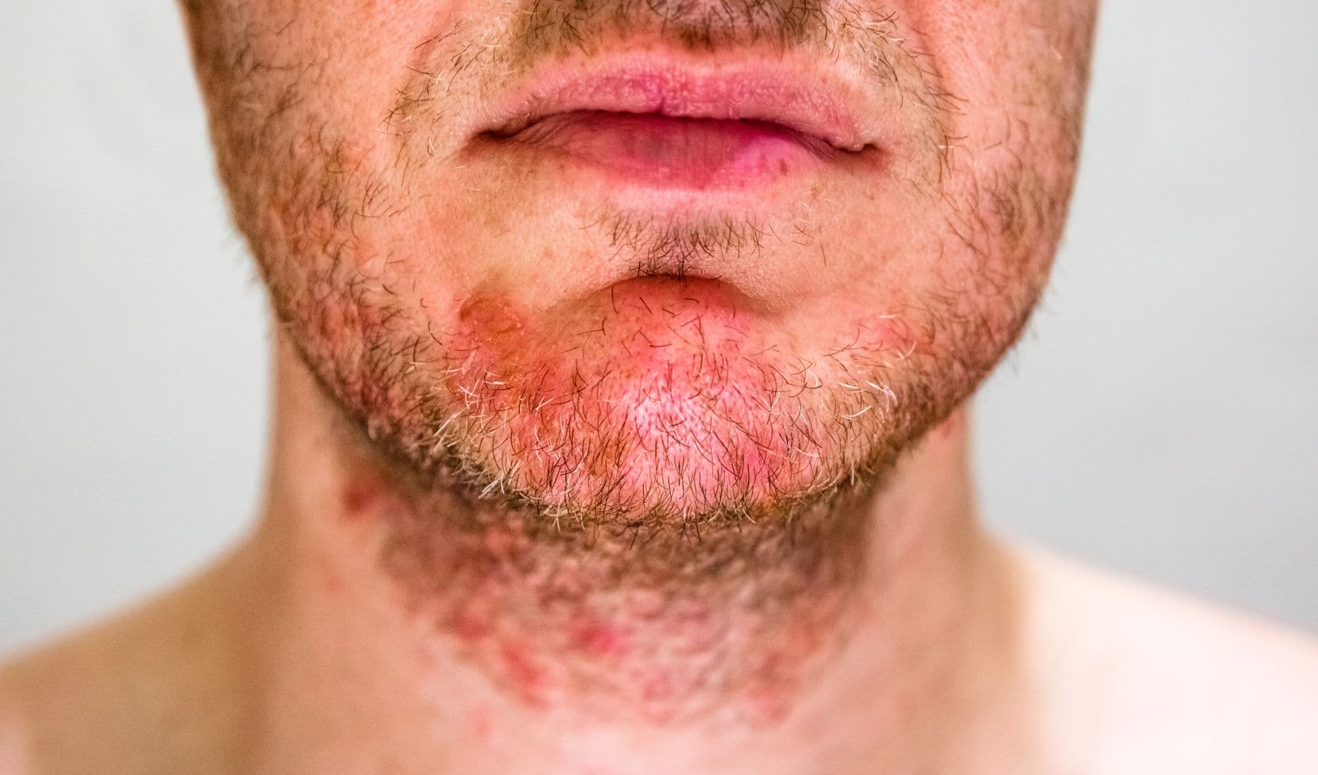 Hilft Feuchtigkeit bei der seborrhoischen Dermatitis?