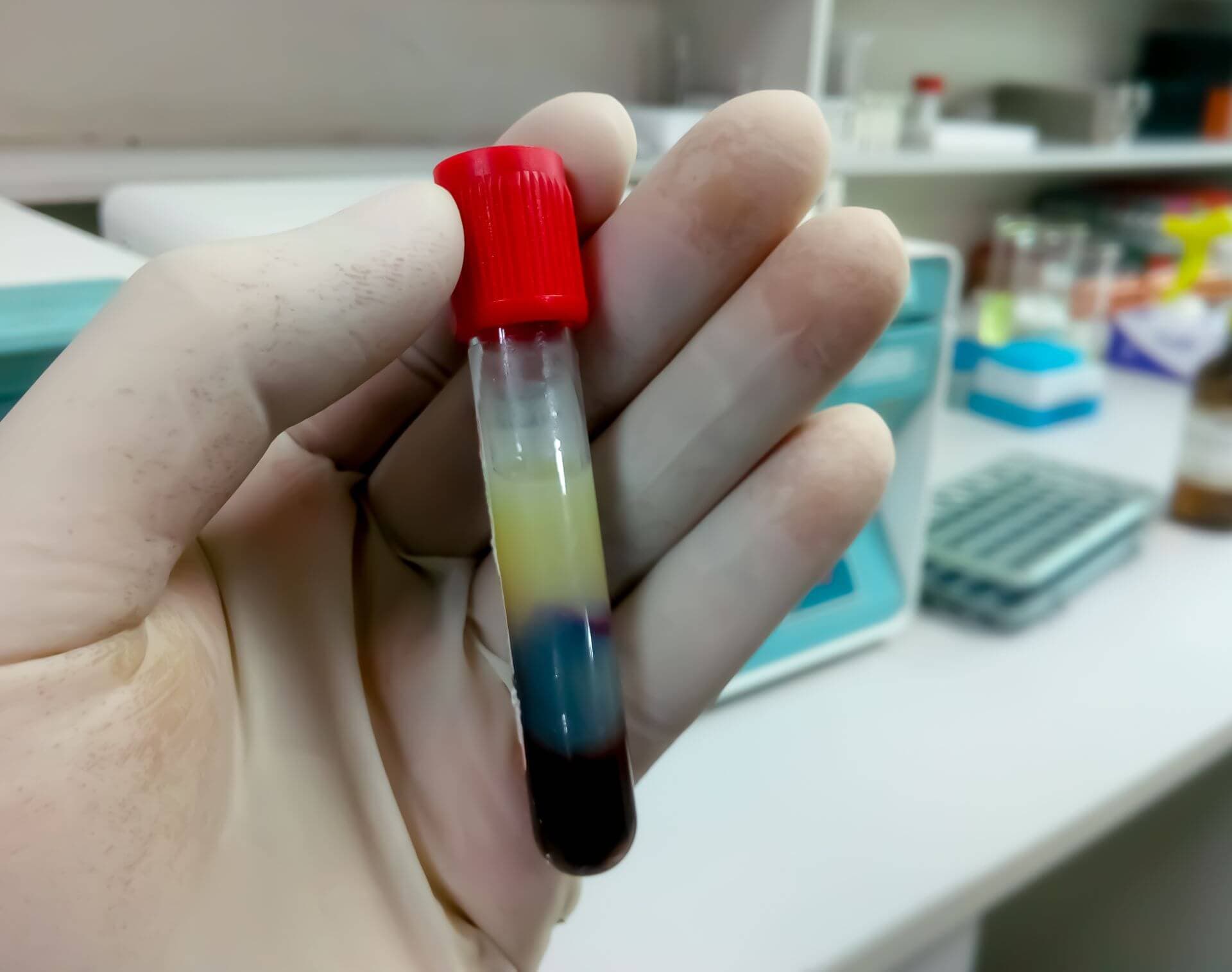 Nach einem Schlaganfall sind hohe Triglyceridwerte schlechte Vorboten