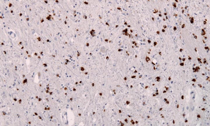 Nachweis alpha-Synuclein-positiver glialer EInschlüsse (braun) im Autopsiepräparat eines Patienten mit MSA