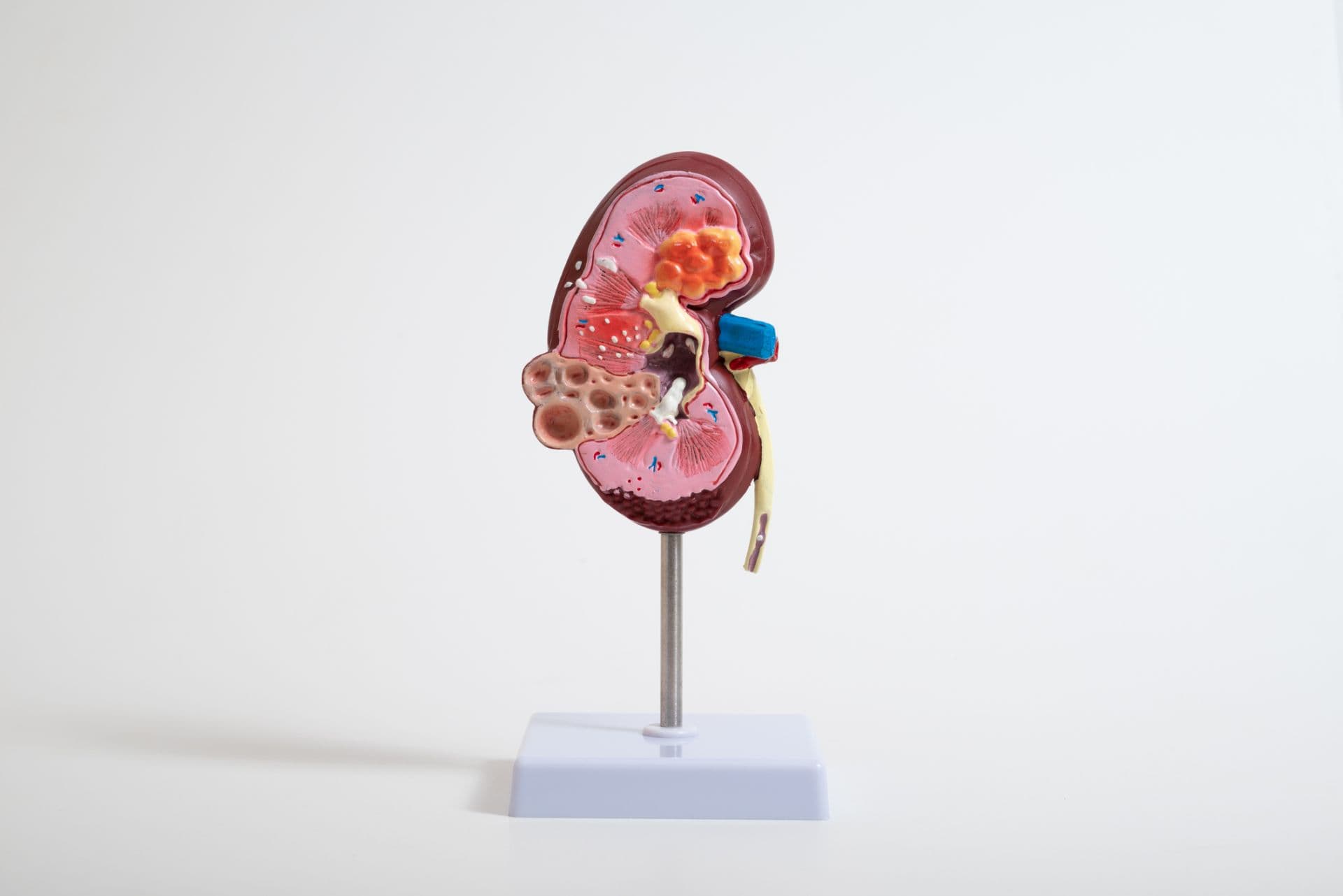 Eine diabetische Nephropathie fällt oft jahrelang nicht auf.