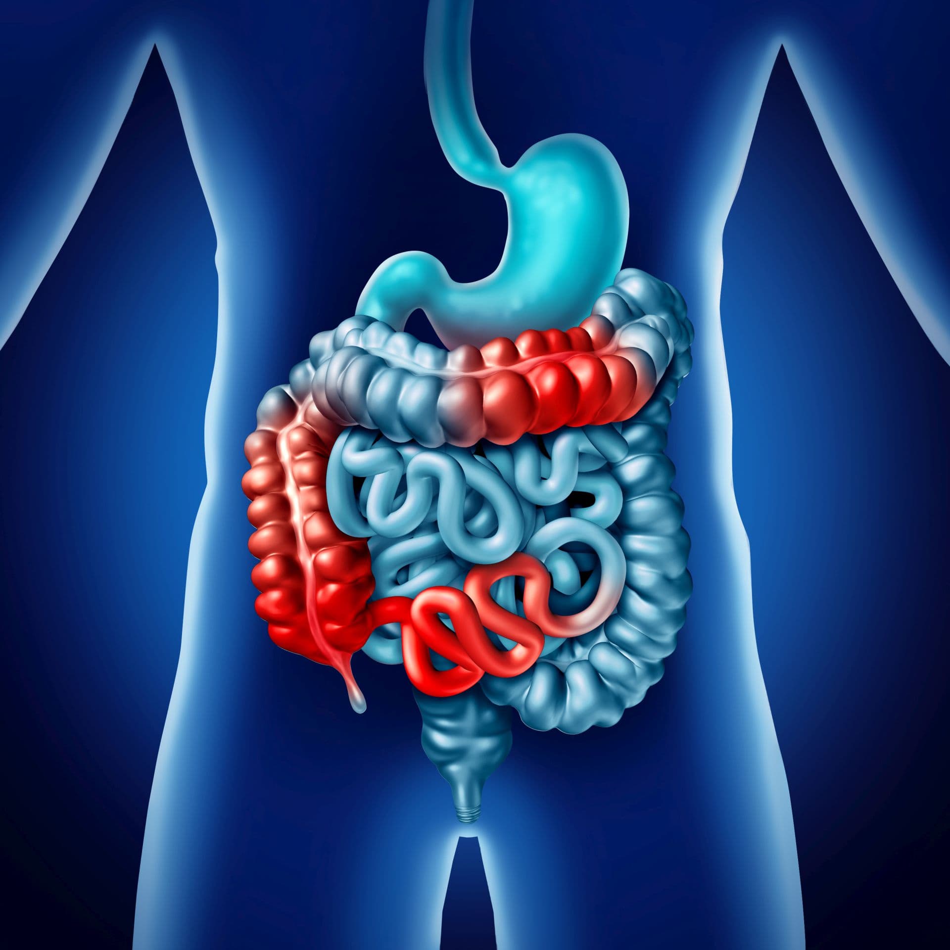 Bei manchen Patienten mit Morbus Crohn kann eine Kombinationstherapie punkten.