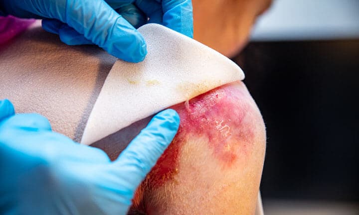 Epidermolysis bullosa symptoms, wound care by a doctor, wound management, butterfly children or EB