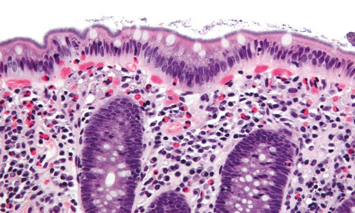 Mikroskopische Aufnahme einer Kolonisierung der kolorektalen Schleimhaut mit Spirochäten