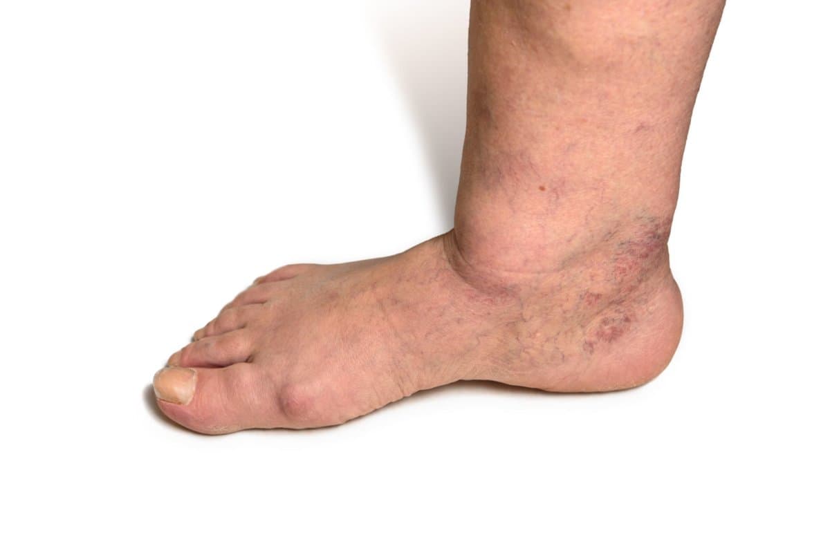 Ein diabetisches Fusssyndrom ist bei rund sechs Prozent aller Diabetiker dokumentiert. Im Alter steigt der Anteil noch an.