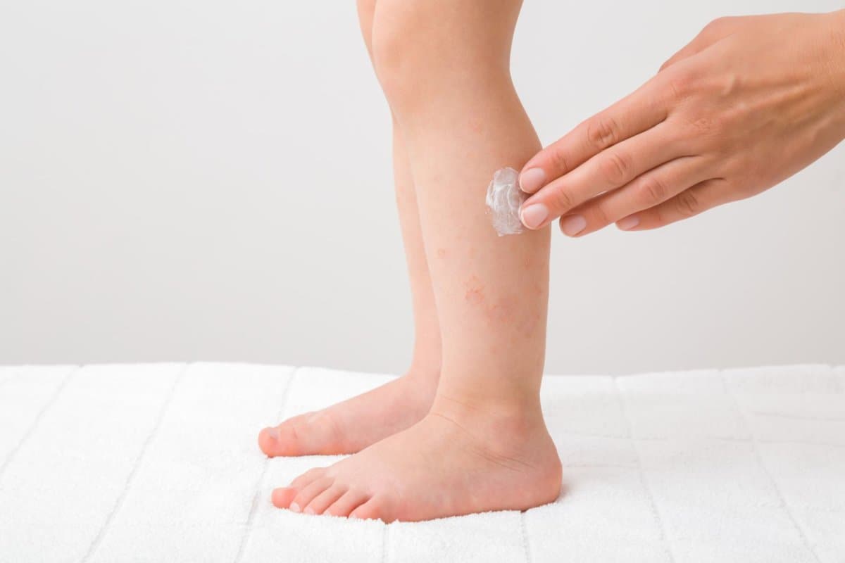 Topische Steroide sind bei Kindern besser als ihr Ruf.