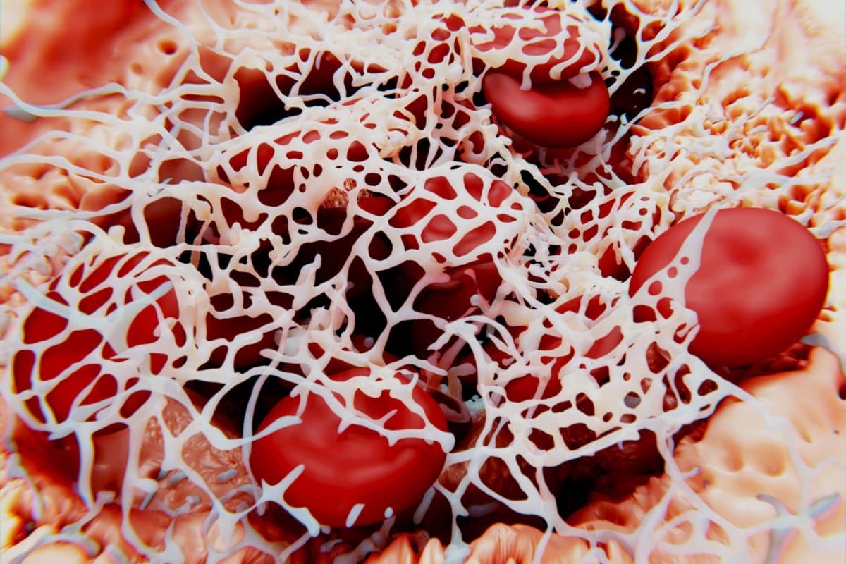 Unter Rivaroxaban plus Thrombozytenaggregationshemmung bestand ein signifikantes Blutungsrisiko.