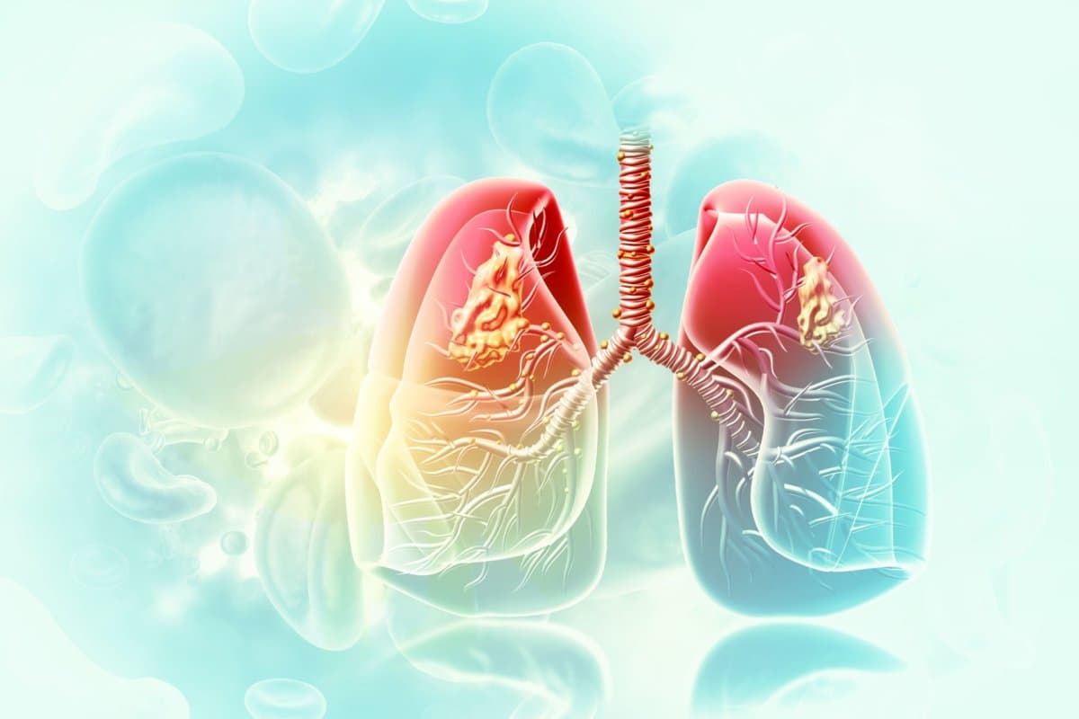 Patienten mit KRAS-mutiertem NSCLC hatten unter Sotorasib weniger Beschwerden.