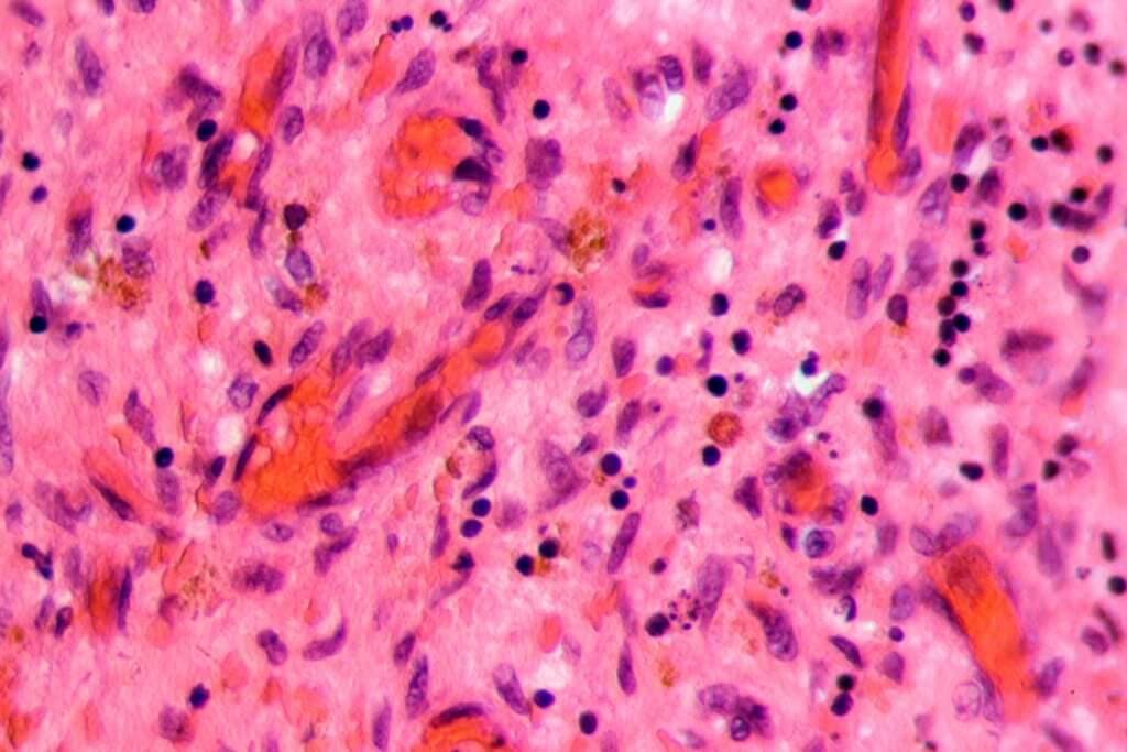 Beim Antiphospholipid-Syndrom können Thrombosen in allen Gefässen auftreten.