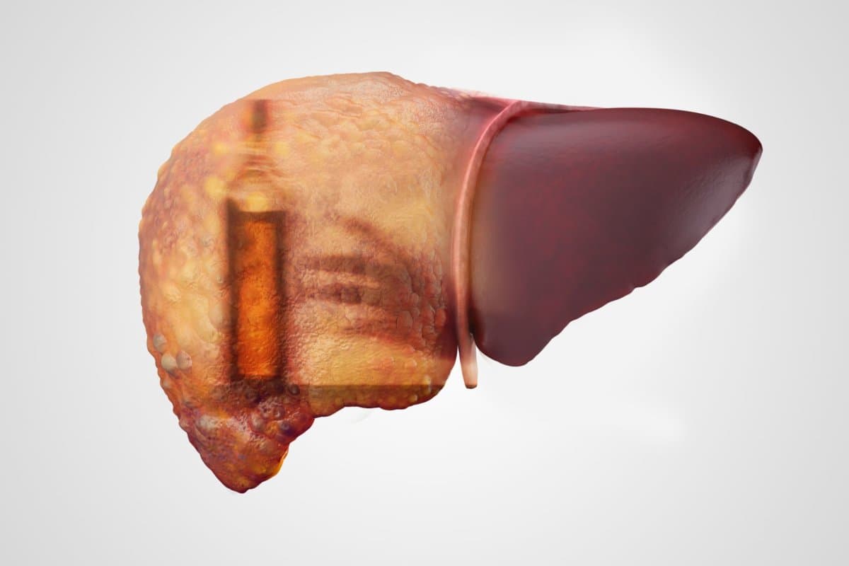 Bei alkoholbedingter Hepatitis gilt es schnell zu handeln.