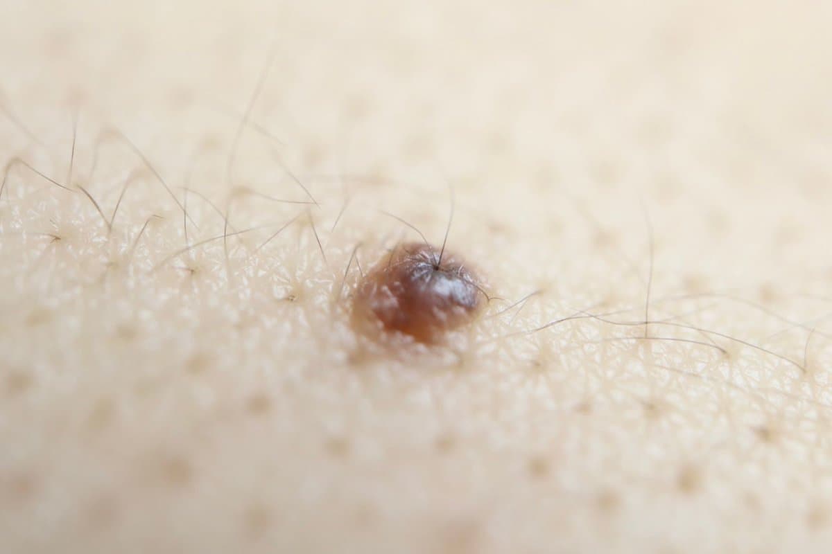 Signalmoleküle in behaarten Muttermalen verstärken das Haarwachstum.