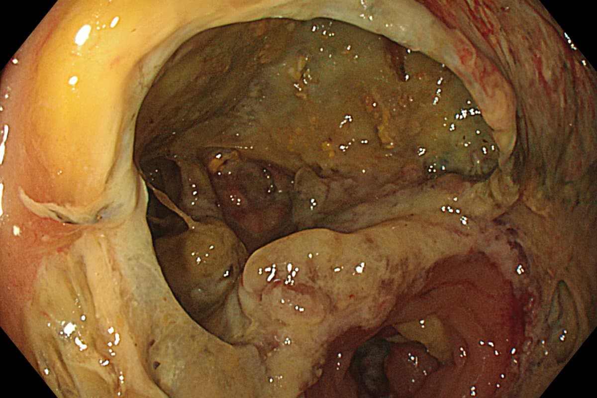 Bei einer Anastomoseninsuffizienz gelangen Verdauungssekrete in den Anastomosenbereich.