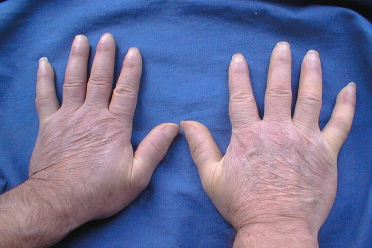 Bei systemischer Sklerose kann Iloprost einige Symptome verbessern.