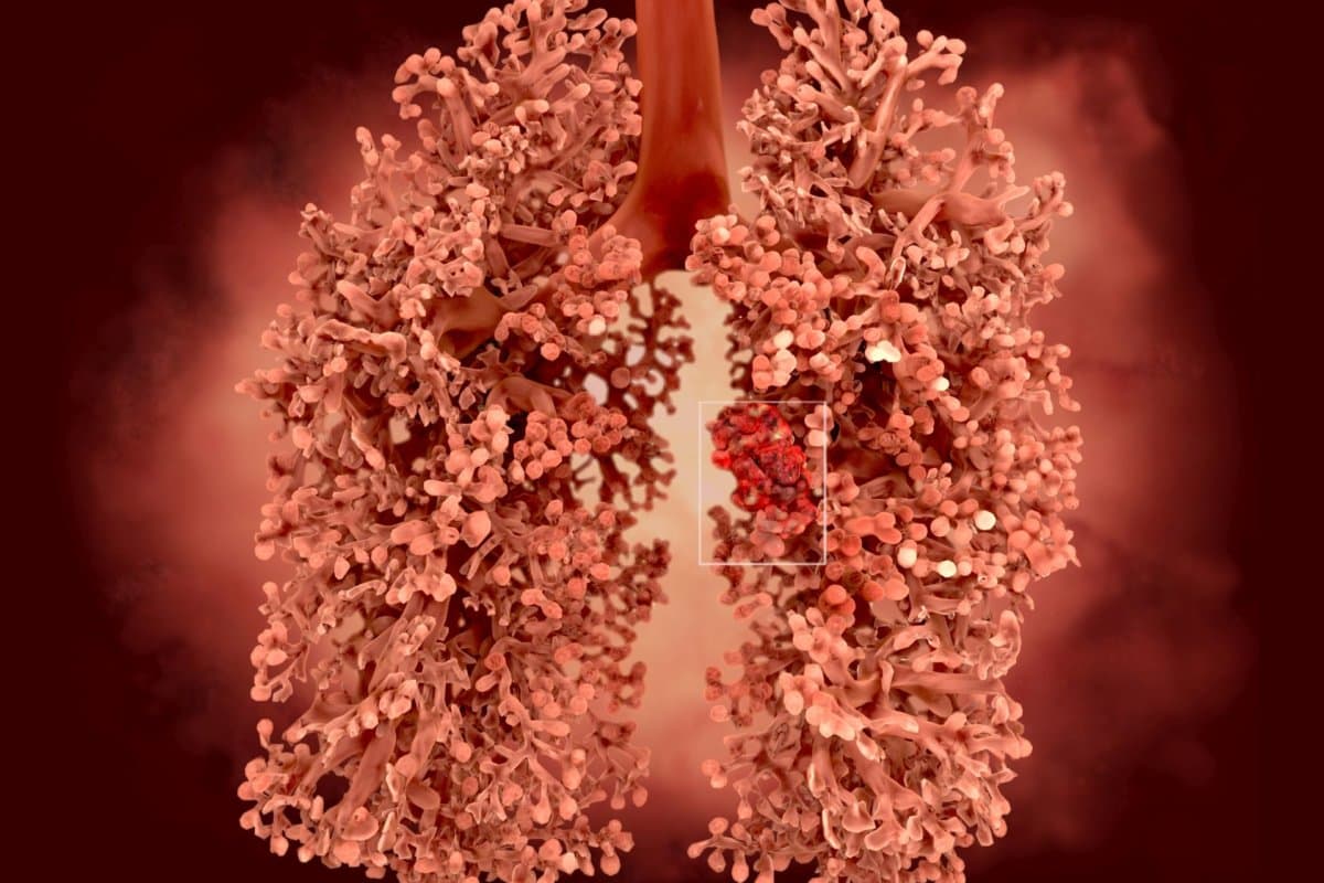 Osimertinib verlängert als erster Tyrosinkinaseinhibitor das Gesamtüberleben.