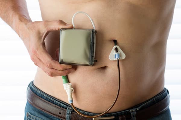 Ein Parkinson-Patient zeigt eine chirurgisch eingesetzte PEG-J-Sonde, die das Antiparkinson-Medikament direkt in den Jejunum transportiert.