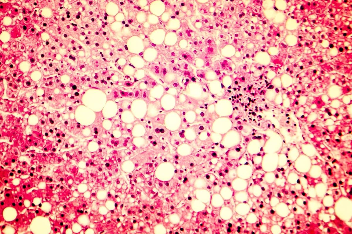 In einer Phase-II-Studie verbesserte das FGF21-Analog Pegozafermin die Fibrose bei NASH.