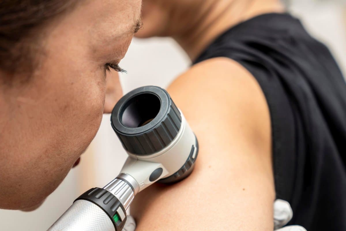 Melanome weisen in der Dermatoskopie unterschiedliche Merkmale je nach Körperregion auf