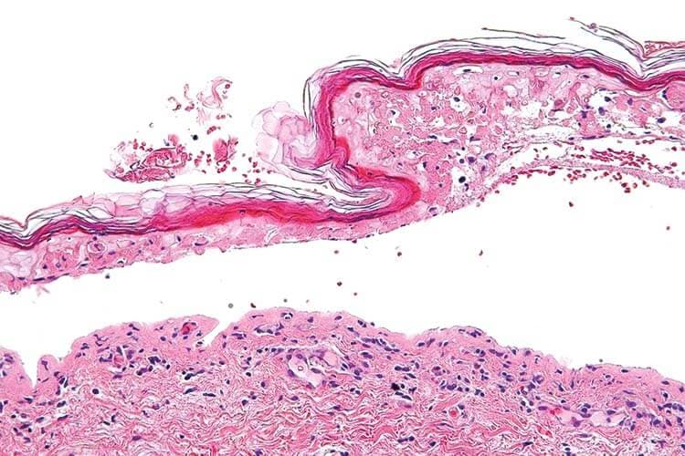 Die Arzneimittelexanthemformen des Steven-Johnsons-Syndrom bzw. der toxischen epidermalen Nekrolyse (TEN) gehen mit einer subepidermalen Spaltbildung zwischen Epidermis und Dermis einher.